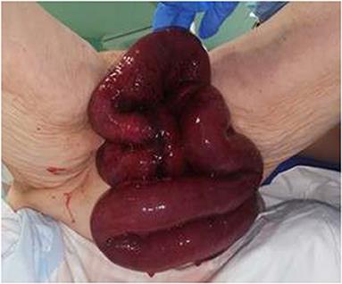 Vaginal Evisceration of Small Bowel With Extraperitoneal Ileal Resection of the Herniated Loops: A Case Report